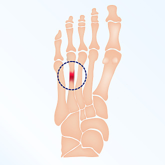 Ankle pain when walking may be related to a fatigue fracture of the humerus