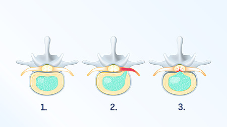 Causes of back pain